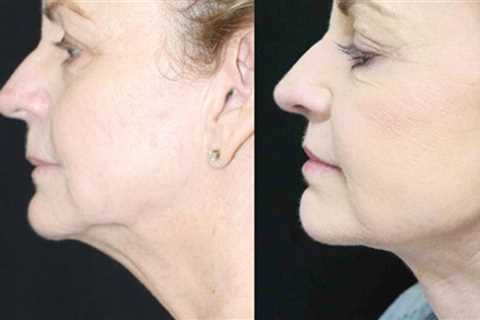 How to Lose Neck Fat and Get a Toned Neck