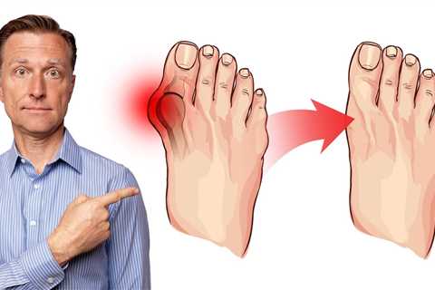 How to Fix Bunions in 3 Steps