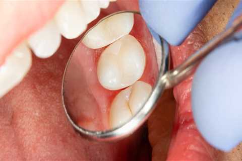 What is cosmetic dental filling?