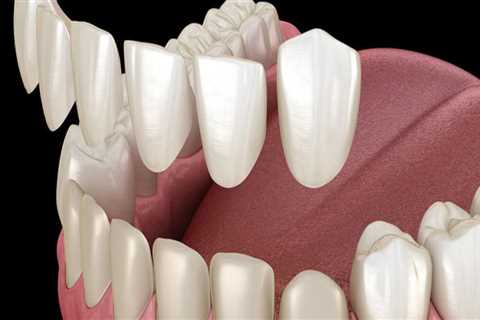 What are porcelain veneers for teeth?