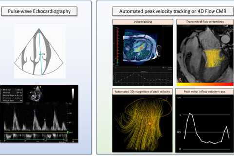 Cutting-edge 4D Flow MRI Scans Could Revolutionize Blood Flow Assessment In The Heart