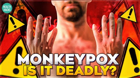 Monkeypox Causes and Symptoms| Health Hacks Infinity