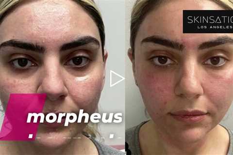 Morpheus8 in Los Angeles: Skinsation LA 90048