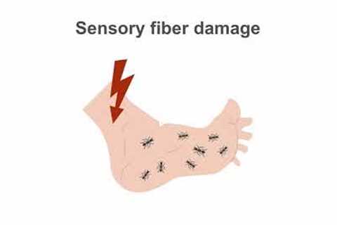 Managing diabetic neuropathy