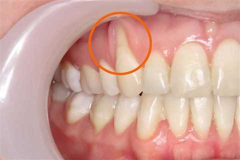 Heal Receding Gums Treatment At Home