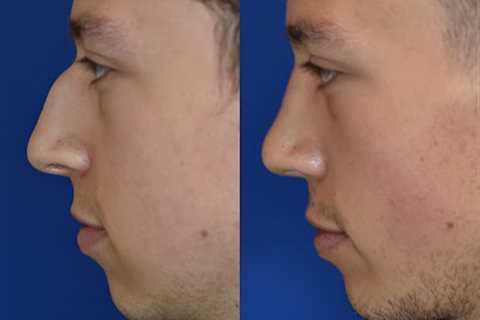 The Portland Center for Facial Plastic Surgery : Rhinoplasty, Facelift Surgery