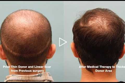 Extracellular Vesicles for Hair Growth - Patient Hair Loss Journey