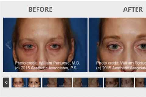 The Seattle Eyelid & Blepharoplasty Center