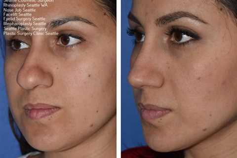 bellevue plastic surgeons | Rhinoplasty, Nose job, Rhinoplasty surgeon