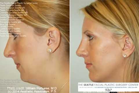 Facelift Surgery in Seattle | Face lift surgery, Facial plastic, Nose job