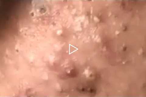 Huge Acne Pimples Blackheads Popping Up Satisfying with Oddly Calm Music