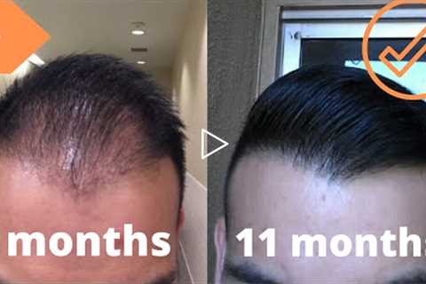 When To Expect Growth After A Hair Transplant *My Timeline