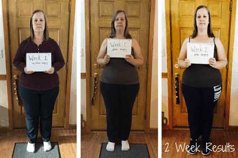 How to Break a Weight Loss Plateau After Gastric Sleeve Surgery