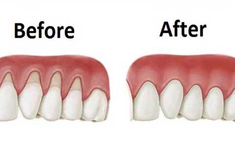 How To Reverse Receding Gums Reddit?