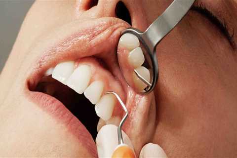 What is the most common cosmetic dental procedure?