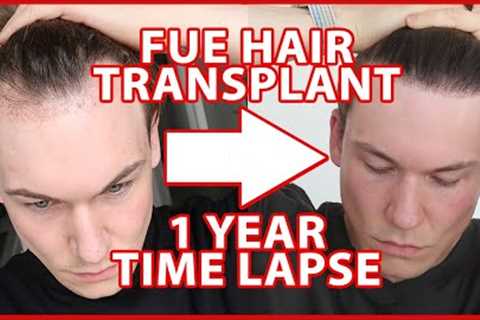 FUE Hair Transplant Timeline 1 YEAR | day 1-365 | 12 Months Progress Before and After
