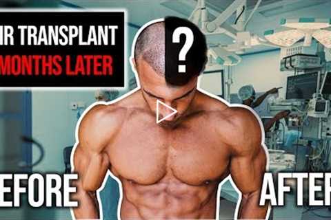 Hair Transplant Results After 6 Months | Before & After