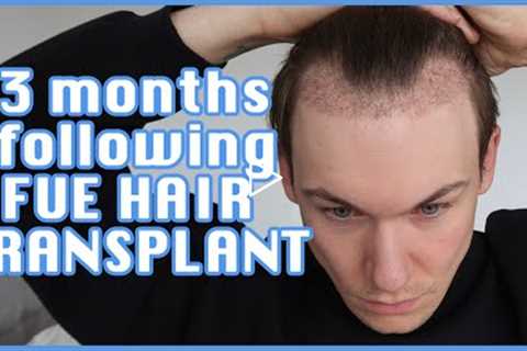 FUE Hair Transplant | Month 3 | Surgery, Swelling, Growth, Before & After, Advice | Progress..