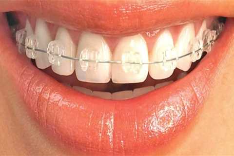 Are clear aligners visible?