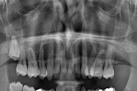 Should dental xrays hurt?