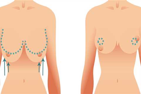 Does Breast Reduction Leave a Scar?