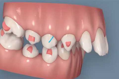 Why are clear aligners faster than braces?