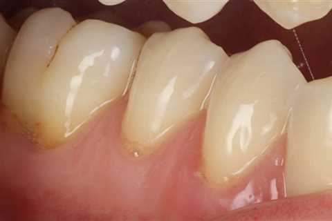 How to Fix an Exposed Tooth Root - Receding Gums Treatment