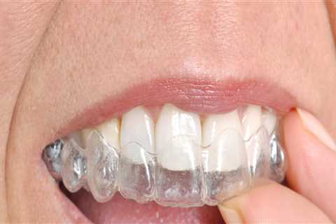 Invisalign In Spring, TX: Your Guide To Straightening Your Teeth With Cosmetic Dentistry