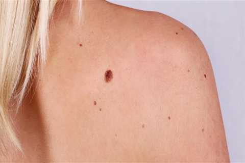 Using Tea Tree Oil For Mole Removal