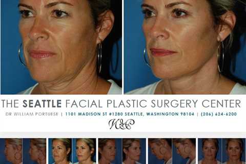 Facelift Surgery Seattle Washington - Face Lift Surgeon
