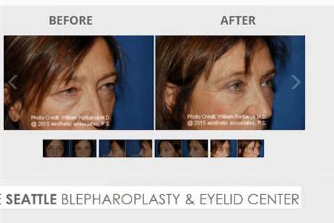 The Seattle Eyelid & Blepharoplasty Center