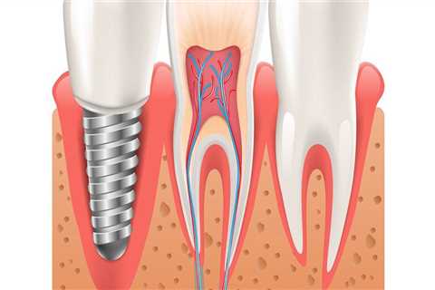 Understanding Health Care Credit Card Plans for Dental Implants