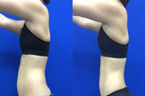 How long after laser liposuction do you see results?