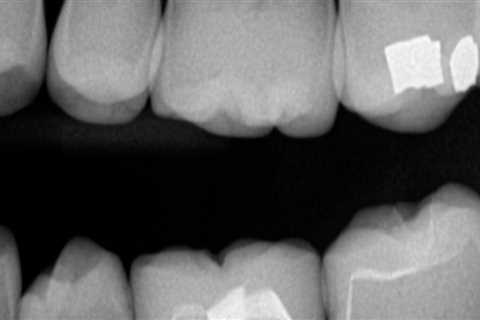 Are dental x rays needed every 6 months?