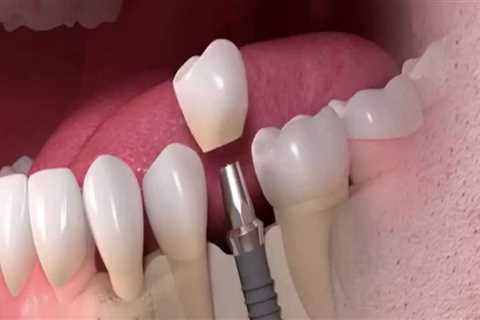 Where are dental implants the cheapest?