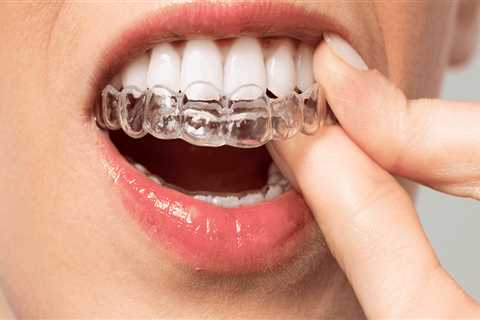 The Benefits Of Invisalign: Why More McGregor Residents Are Choosing Clear Aligners