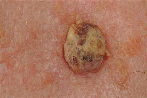 What Are the Signs and Symptoms of Squamous Cell Carcinoma?