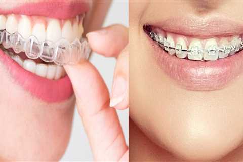 Are Clear Aligners Really the Same?