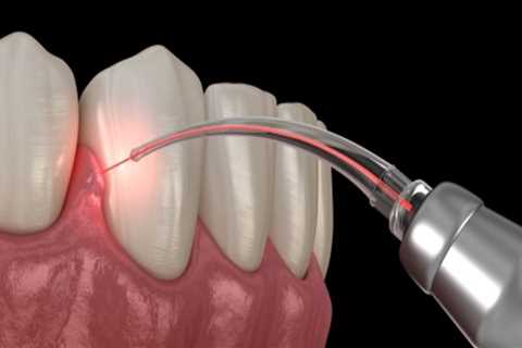 What are the Benefits of Laser Teeth Cleaning?