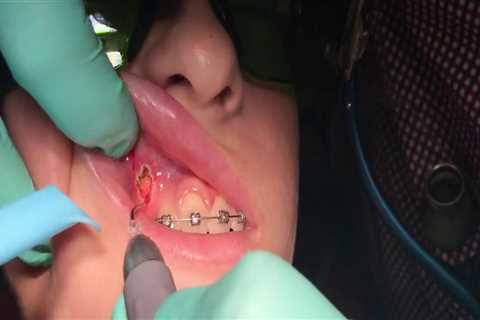 Can I Get a Dental Laser Cleaning with Braces?