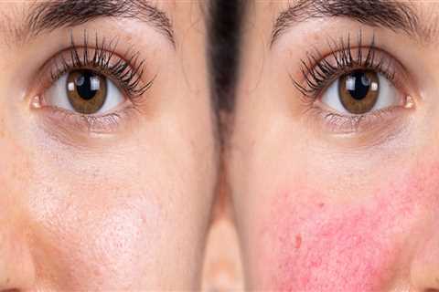 Understanding Rosacea: Causes, Symptoms, and Treatment