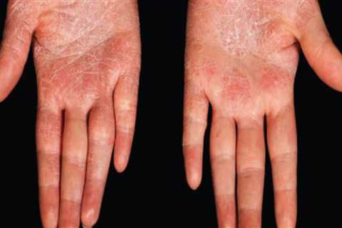 Psoriasis Treatments: A Comprehensive Overview