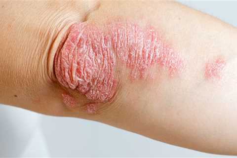 Psoriasis: Overview of Causes, Symptoms, and Treatments