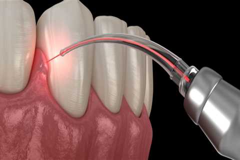 What are the Benefits of Dental Laser Cleaning?