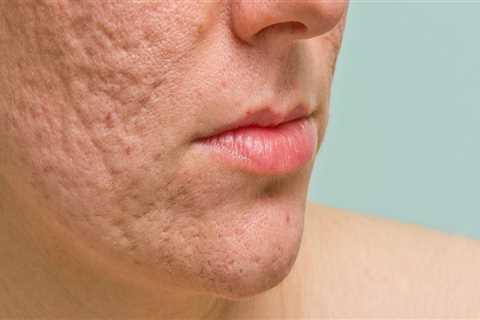 Microdermabrasion for Acne Scars: What You Need to Know
