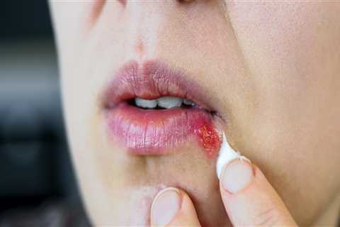 Topical Treatments for Herpes Relief