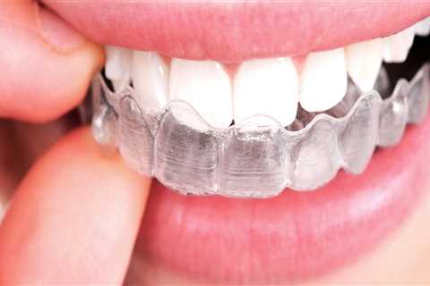 Caring for Your Invisalign Clear Braces: A Guide