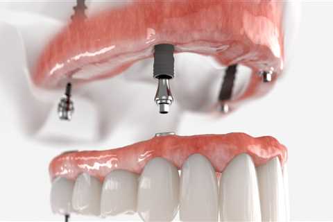What is the Difference Between Snap-in Dentures and All-on-4 Implants?