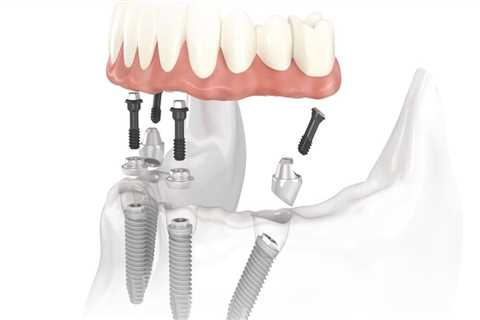 The Advantages of All-On-Four Dental Implants