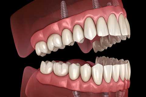 Brushing and Flossing with All on Four Dental Implants